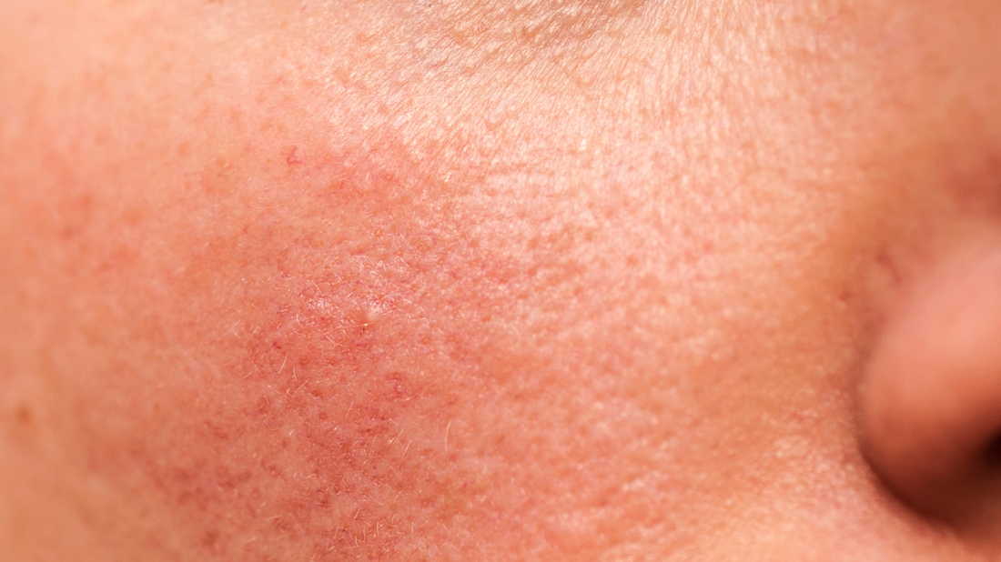 How to Repair a Damaged Skin Barrier (Step-by-Step)